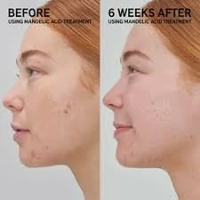 The INKEY List Mandelic Acid Treatment NEW IN